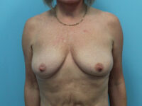 Augmentation & Mastopexy
