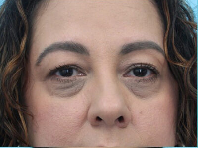 Blepharoplasty