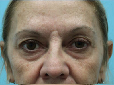 Blepharoplasty
