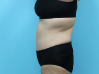 Abdominoplasty