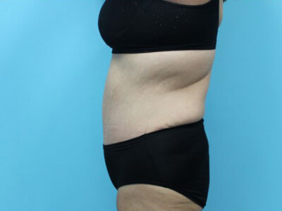 Abdominoplasty