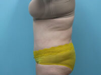 Abdominoplasty