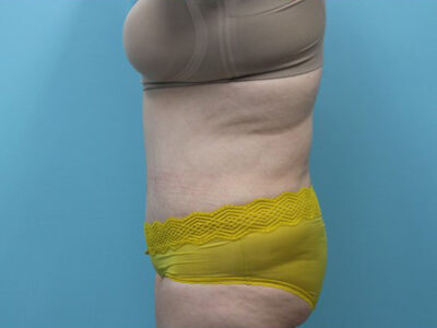 Abdominoplasty