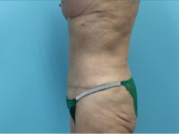 Abdominoplasty