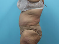 Abdominoplasty