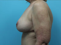 Augmentation & Mastopexy