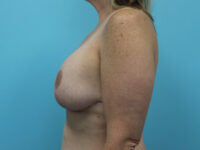 Augmentation & Mastopexy