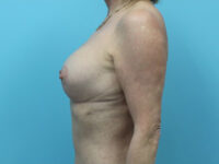 Augmentation & Mastopexy