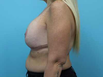 Augmentation & Mastopexy