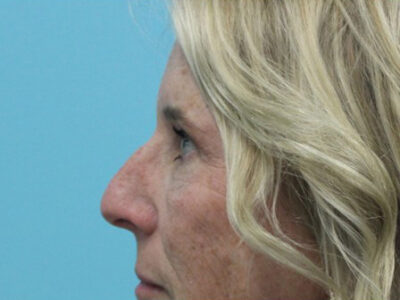 Blepharoplasty