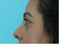 Blepharoplasty