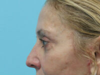 Blepharoplasty