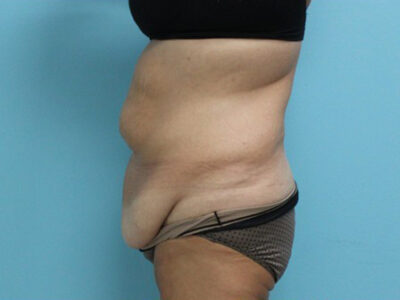 Abdominoplasty