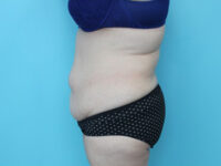 Abdominoplasty