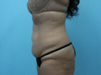 Abdominoplasty