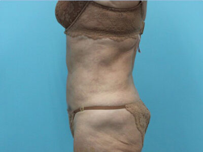 Abdominoplasty