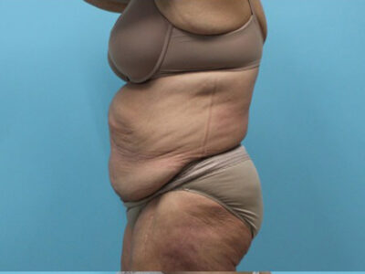 Abdominoplasty