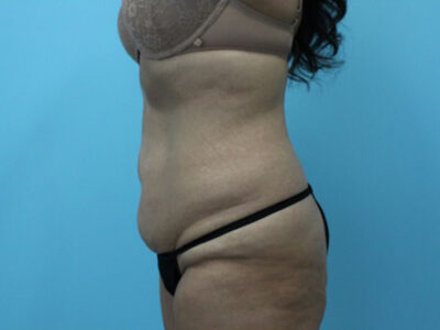 Abdominoplasty
