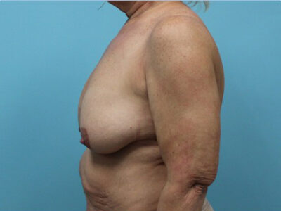 Augmentation & Mastopexy