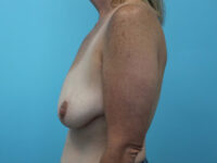 Augmentation & Mastopexy