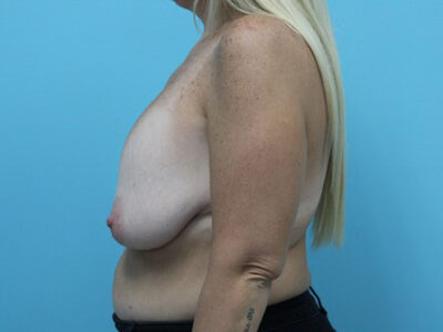 Augmentation & Mastopexy