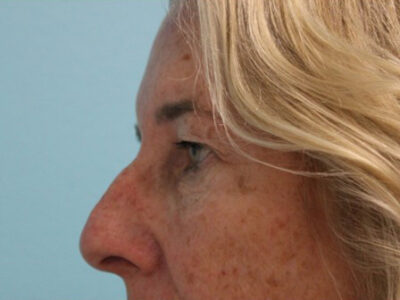 Blepharoplasty