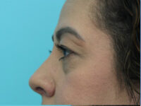 Blepharoplasty