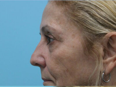 Blepharoplasty
