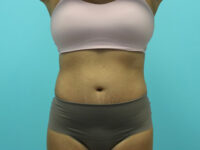 Liposuction