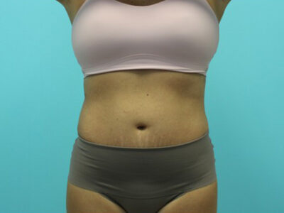 Liposuction