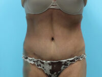 Liposuction