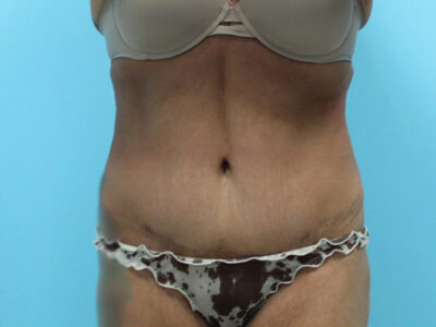 Liposuction