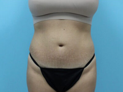 Liposuction