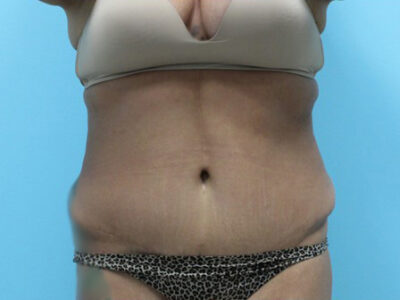 Liposuction