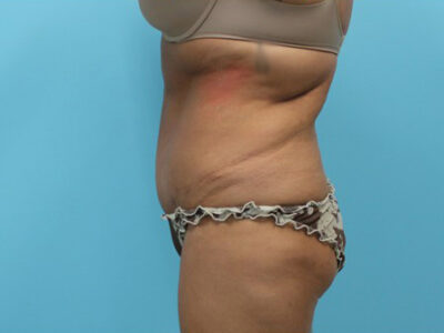 Liposuction