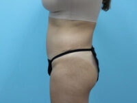 Liposuction