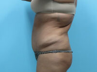 Liposuction