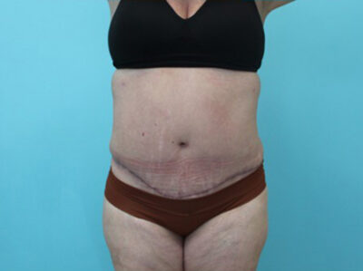 Abdominoplasty