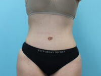 Abdominoplasty