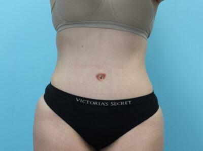 Abdominoplasty
