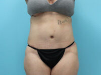 Abdominoplasty