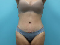 Abdominoplasty