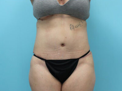Abdominoplasty