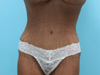 Abdominoplasty