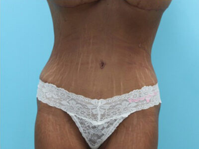 Abdominoplasty