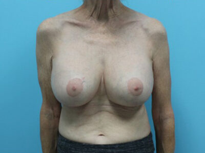 Augmentation & Mastopexy