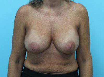 Breast Implant Exchange