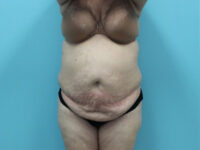 Abdominoplasty