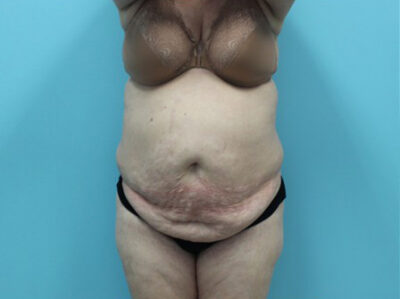 Abdominoplasty