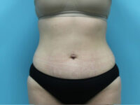 Abdominoplasty